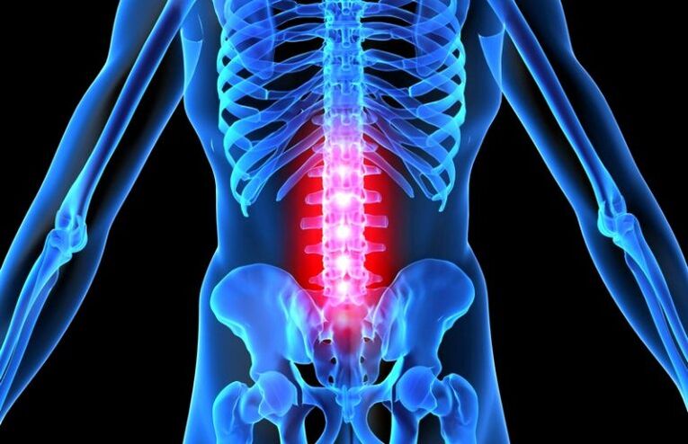 leziune a coloanei vertebrale cu osteocondroză lombară