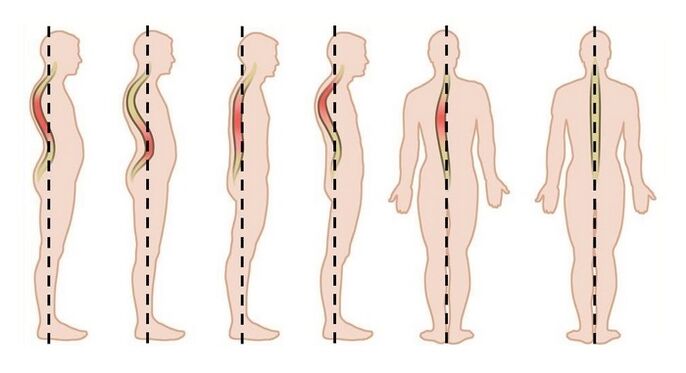 tulburări de postură ca cauză a osteocondrozei toracice