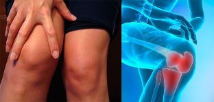 Disconfortul și umflarea în zona genunchiului sunt primele simptome ale artrozei