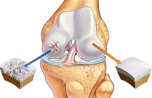 cauzele artrozei articulației genunchiului